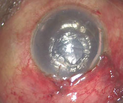 Figure 4. Anterior chamber is well-formed