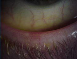 Off-label use of AzaSite showed promising results in treating blepharitis