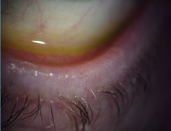 Off-label use of AzaSite showed promising results in treating blepharitis