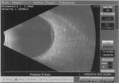 Figure 2. B-scan demonstrating a 2.4-mm elevation of a choroidal lesion