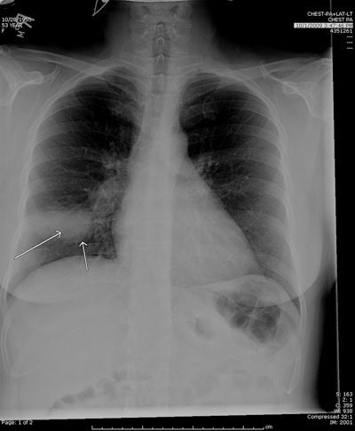 Figure 3. Posterior-anterior chest X-ray showing a bronchogenic adenocarcinoma