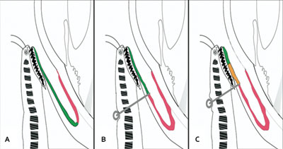 Figure 1. Three surgical strategies for fornix reconstruction.