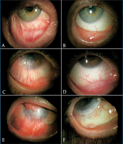 Figure 2. Photographs showing the fornix reconstruction