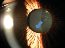 Pseudoexfoliation material is seen on the anterior lens capsule