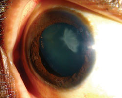 An eye with an excessively deep anterior chamber and a traumatic cataract