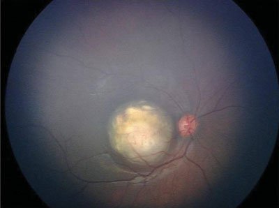 Figure 1.  A solid-looking, round, elevated, yellow-white lesion