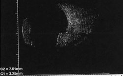 Figure 2b. B-scan ultrasound image of the lesion