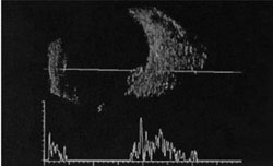 Figure 2c. A-scan showed a high spike of internal reflectivity