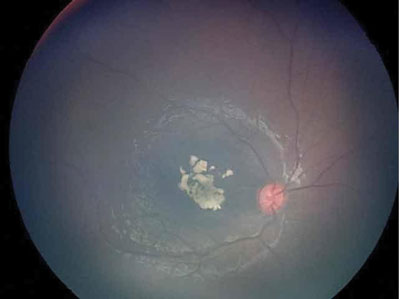 Figure 3.  At 6 months, the retinoblastoma had regressed 