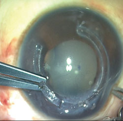 Figure 3. Once the first segment has gone through, the second segment is inserted