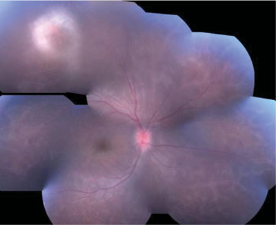 Figure 1. Fundus photograph of the right eye taken at initial presentation