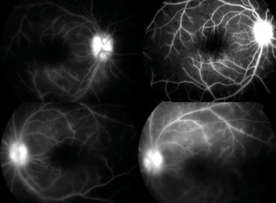 Figure 2. Fluorescein angiograms from both eyes