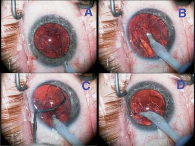 Highly myopic eyes are prone to excessive deepening of the anterior chamber