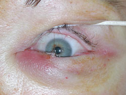 Full-thickness eyelid defect.