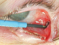 Conjunctival incision and transconjunctival cantholysis.