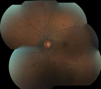 Figure 2. Dilated fundus examination