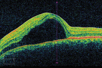 Figure 3. Serous detachment in the macula