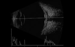 Figure 5. B-scan ultrasound demonstrated scleral thickening