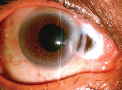 Figure 1. Acute scleral thinning