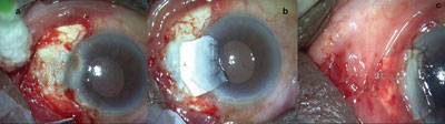 Figure 2. A: Thinned scleral bed area exposed.