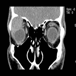 Figure 2. A CT scan of the orbit with contrast was performed