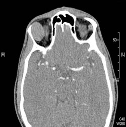 Figure 2. A CT scan of the orbit with contrast was performed