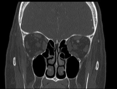 Figure 2. Coronal CT image showing enlarged rectus muscles of the left eye