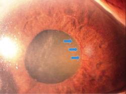 Anterior segment neovascularization, such as the rubeosis iridis pictured here