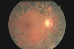 This patient has a quiescent retina with a preserved macula