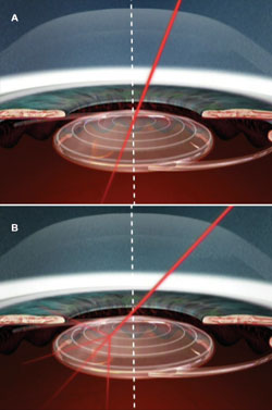 Figure 2. A: In eyes with small angle kappa