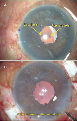 Figure 3. A glued multifocal IOL being done in an aphakic eye