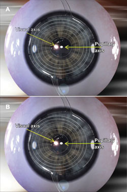 Figure 4.  A: A multifocal IOL that is centered on the pupillary axis 