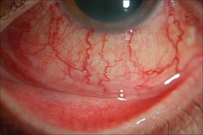 Figure 1. Left eye: Dilated corkscrew-shaped conjunctival vessels