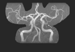 Figure 2.  MRA with arrow 