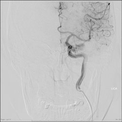 Figure 3. Angiogram and treatment.