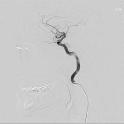 Figure 3. Angiogram and treatment.