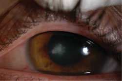 Anterior segment photos of the left eye