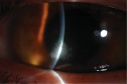 Anterior segment photos of the left eye