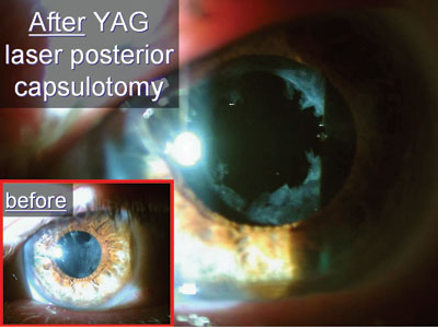 PCO can be addressed using the YAG laser 