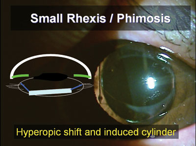 The small capsulorrhexis in this patient