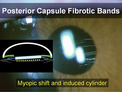 Fibrotic bands along the posterior capsule