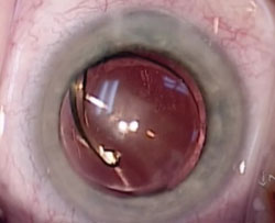 Figure 2. Even after manipulation and rotation of the IOL