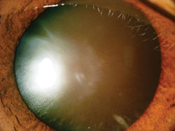 Figure 1. Black cataract.