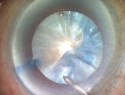 Figure 2. Rhexis running away in a hard brown cataract.