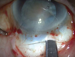 Figure 3. Conversion to manual non-phaco technique