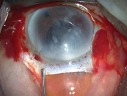 Figure 4. The nucleus is delivered manually.