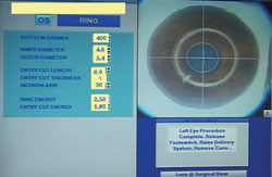 Figure 2. SI-5 IntraLase screen setting with an inner diameter of 4.8 and outer diameter of 5.4.