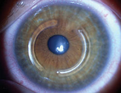 Figure 3. Clinical photograph of implanted intracorneal ring segments.