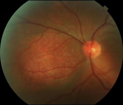 Figure 1. Fundus photograph of the left eye taken at initial presentation