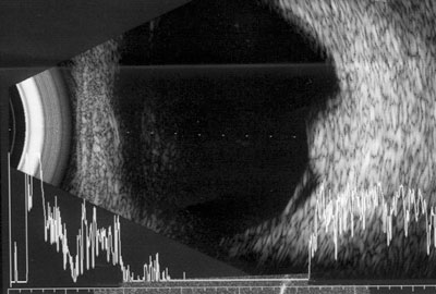 Figure 2. B-scan demonstrated a 4-mm elevation of a choroidal lesion